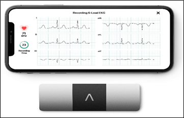 AliveCor brings world’s only six-lead, FDA-cleared personal ECG to India